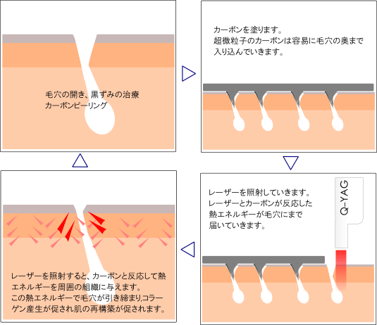 カーボンピーリングの実際