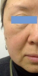 ヒアルロン酸注入　ほうれい線ゴルゴ線　リフトアップ施術前