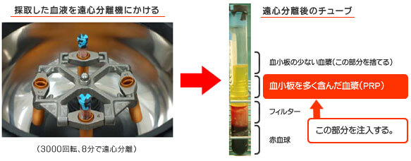 PRP皮膚再生療法　ACR療法　リジェンACR療法