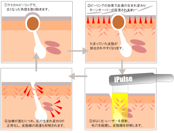 iPulseフォトセラピーによるにきび治療 iPulseフォトセラピーによるにきび治療