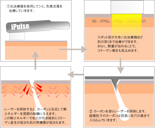 混合シミ改善治療 シミ、毛穴,にきび にきび跡,シワたるみの治療に効果的な治療です。