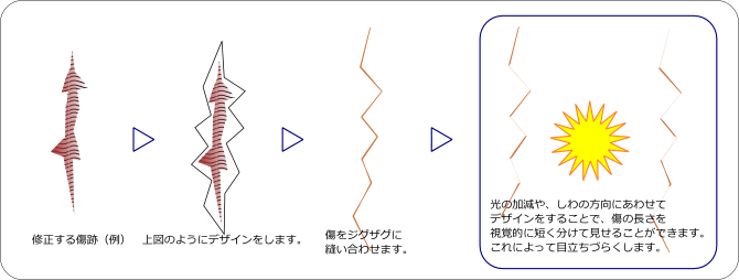 傷跡手術　瘢痕修正術