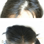 女性の薄毛・育毛発毛治療HARG療法 女性の薄毛・育毛発毛治療HARG療法