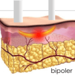 bipoler