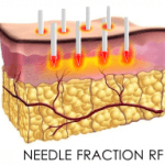 NEEDLE FRACTION RF