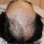 育毛治療 症例写真 01 治療前の写真 前頭部から頭頂部にかけての脱毛症