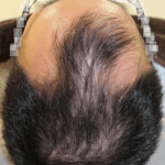 毛髪再生治療後6週間 薄毛の治療後6週間