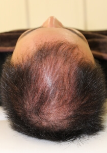 薄毛の発毛治療　前