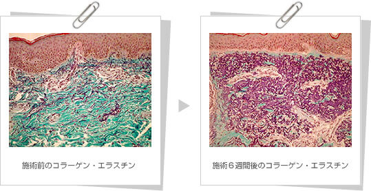 ダーマローラー療法は、コラーゲン,エラスチンを増加させます。
