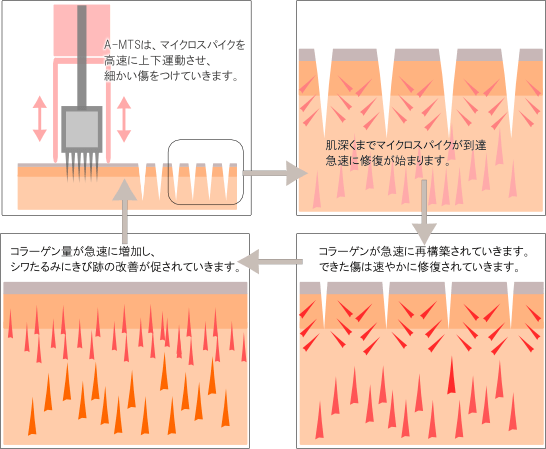 新型ダーマローラーAMTSは、マイクロスパイクで皮膚を活性化　修復を促します。