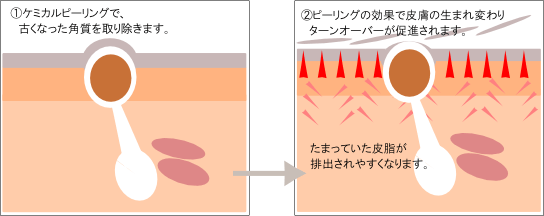 ケミカルピーリングによるにきび治療