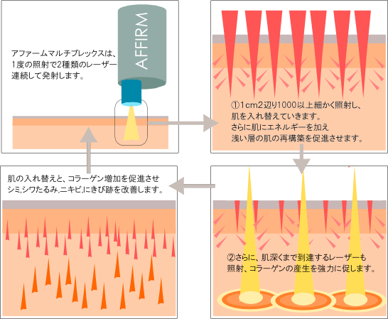 アファームマルチプレックス　詳細　ニキビ、にきび跡　シミしわたるみの治療に効果的