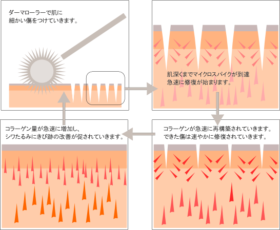 ダーマローラー療法 詳細