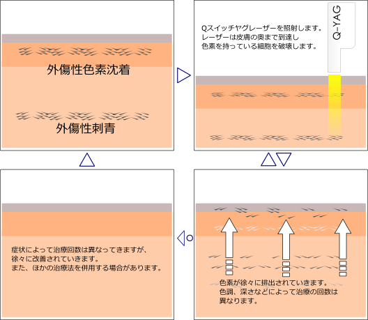 Qスイッチヤグレーザーによる外傷性刺青、色素沈着などの除去