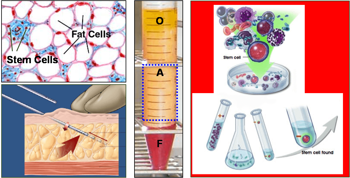 ２０歳の女性より提供された脂肪幹細胞を培養増殖させ成長因子を製剤化