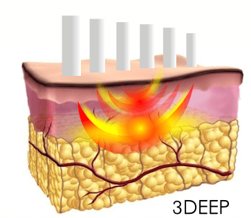 3DEEPテクノロジーによって真皮を効率的に3次元加熱することで、コラーゲン造成を促します。