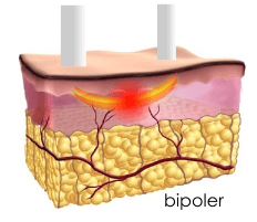 ポラリスなどのバイポーラ方式は、皮膚深層での熱量発生には不向きです。