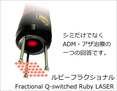フラクショナルQスイッチルビーレーザー