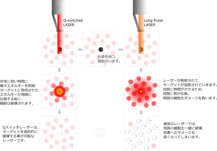 色素を持つ細胞のみを選択的に破壊するQスイッチレーザー