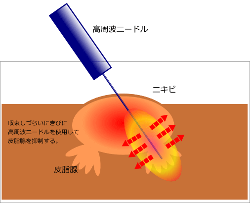 小林メソッドに準じ高周波ニードルで皮脂腺を破壊します。