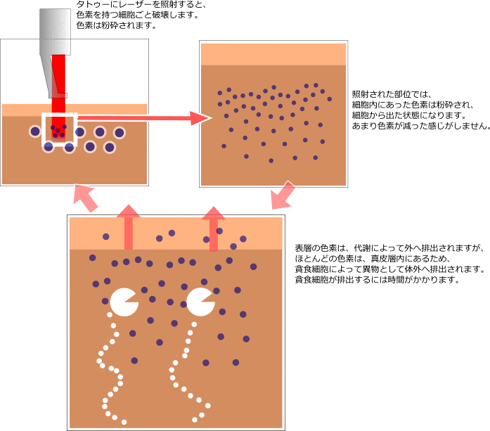 タトゥー除去レーザー作用機序