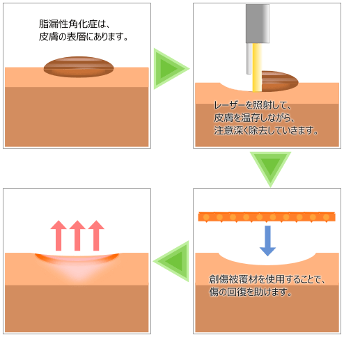 脂漏性角化症・イボの治療