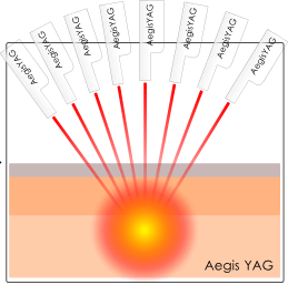 イージスヤグの照射方法FMLB　微細なレーザーを多方向から照射して目的の深さに熱量を発生させます。