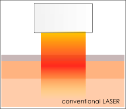通常のレーザー照射。上から照射されるため、皮膚表面も一緒に熱影響を受けます。