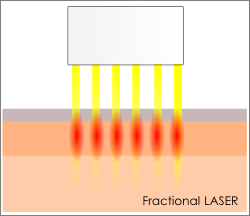 フラクショナルレーザーは、皮膚表面への影響を減少させるために　微細なレーザーに分割し　ダメージを減少させダウンタイムを軽減しています。
