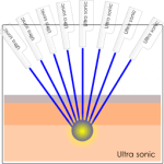 aegisyag ultrasound