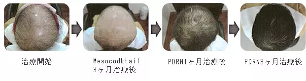 発毛治療　PDRN療法