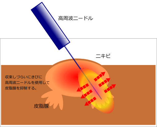 ニキビ RF-needle.png