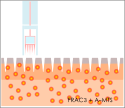 FRAC3-AMTS-small