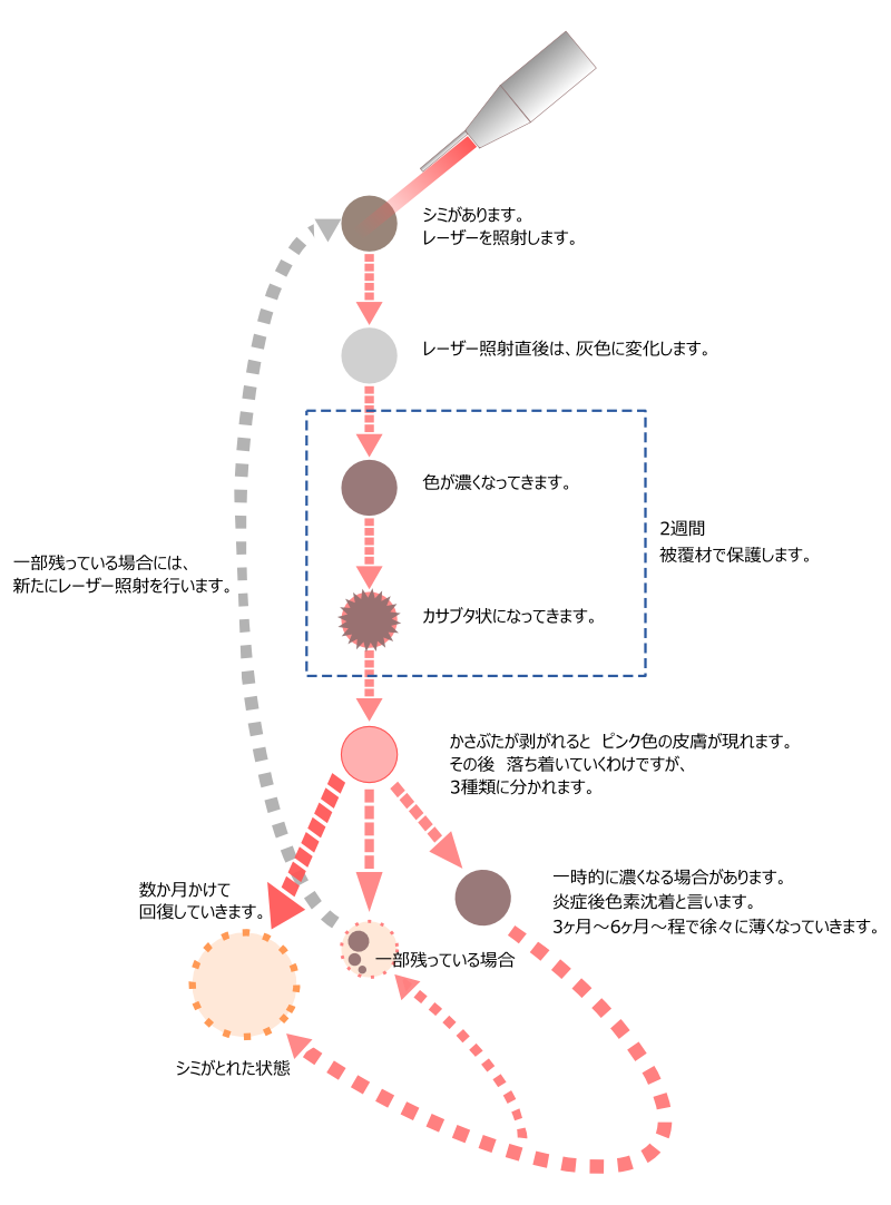 シミ取りレーザーの機序