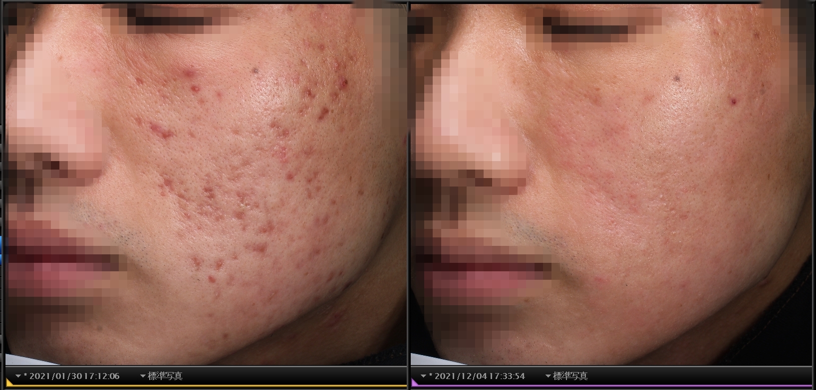 治るまでどれくらいかかりますか?