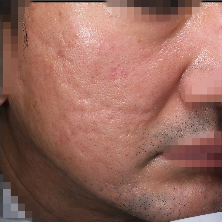 ニキビ跡治療-症例写真　40代男性　治療前 Before