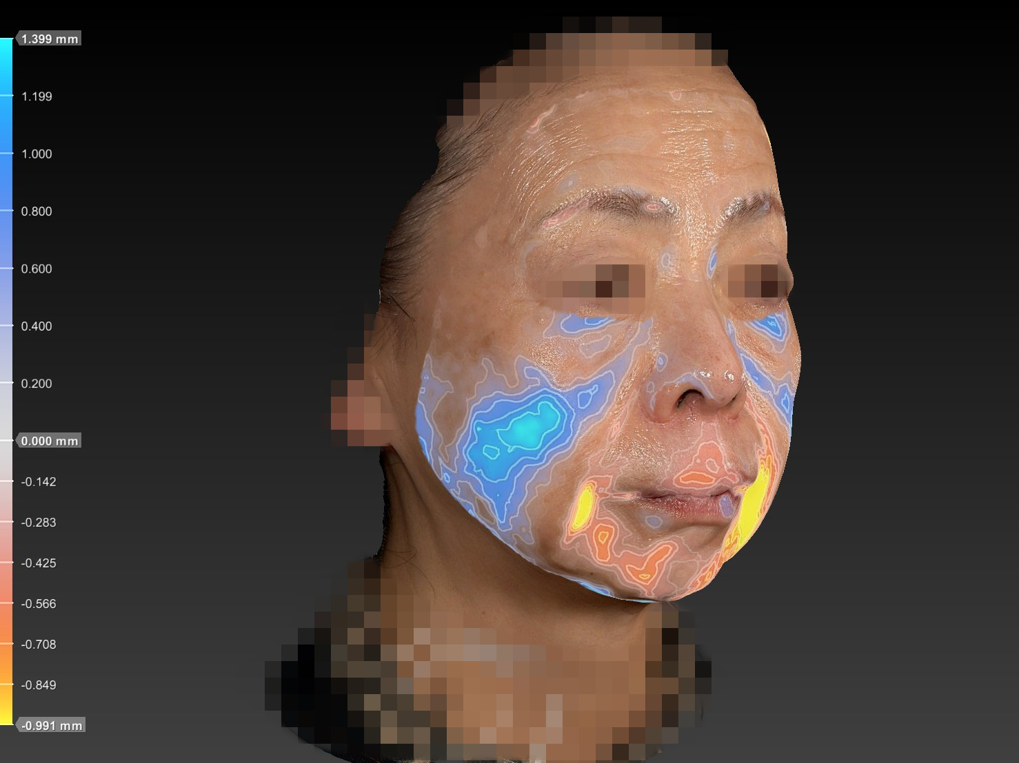 70代女性症例写真:VECTRA肌画像分析によるリフトアップ効果