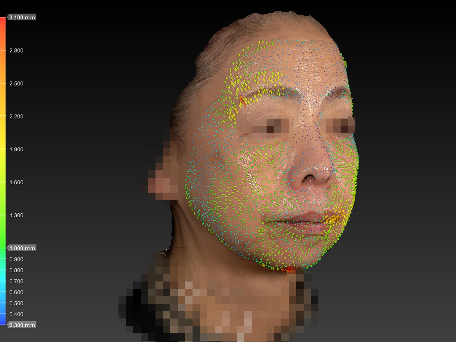 70代女性 リフトアップ症例写真(VECTRA分析)