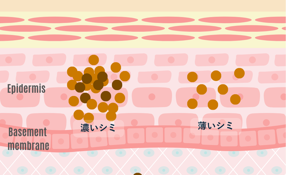 濃いシミと薄いシミ(日光性色素斑)の概念図。