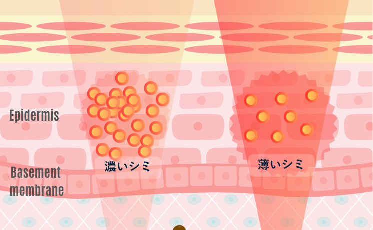 濃いシミ(日光性色素斑など)は、メラニンが密集しているためレーザーの反応が十分に発揮するが、薄いシミは同じ出力だと不十分になる。強力な照射では周囲にも影響が出るため、炎症後色素沈着などの副作用リスクが高まる。