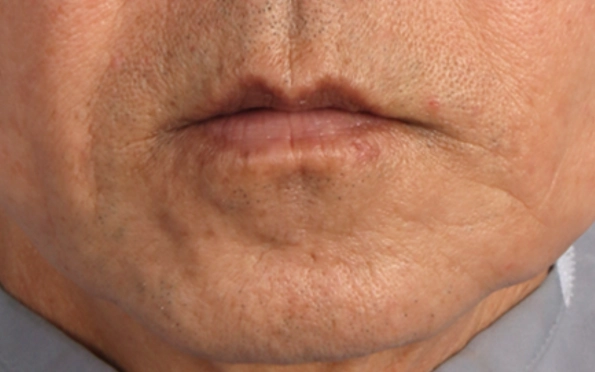 XERF症例写真 60代男性 マリオネットライン しわ_たるみの改善 After