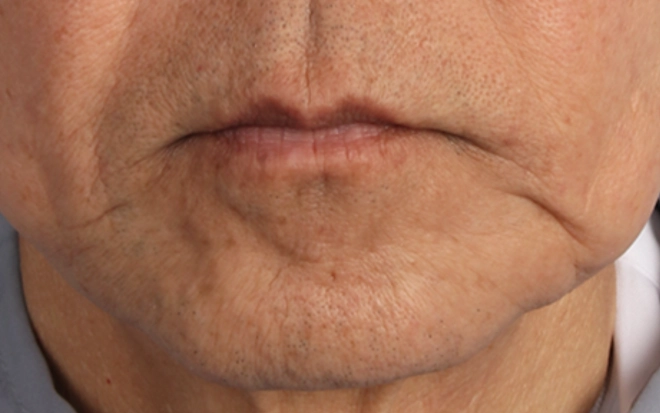 XERF症例写真 60代男性 マリオネットライン しわ_たるみの改善 Before