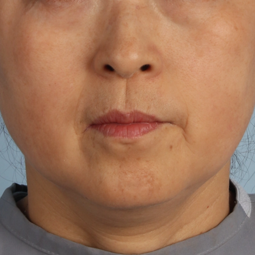 XERF症例写真50代女性 V_line 顎下のボリュームダウン After