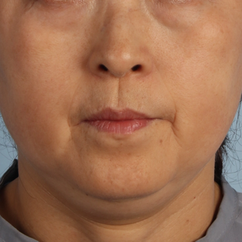 XERF症例写真50代女性 V_line 顎下のボリュームダウン Before