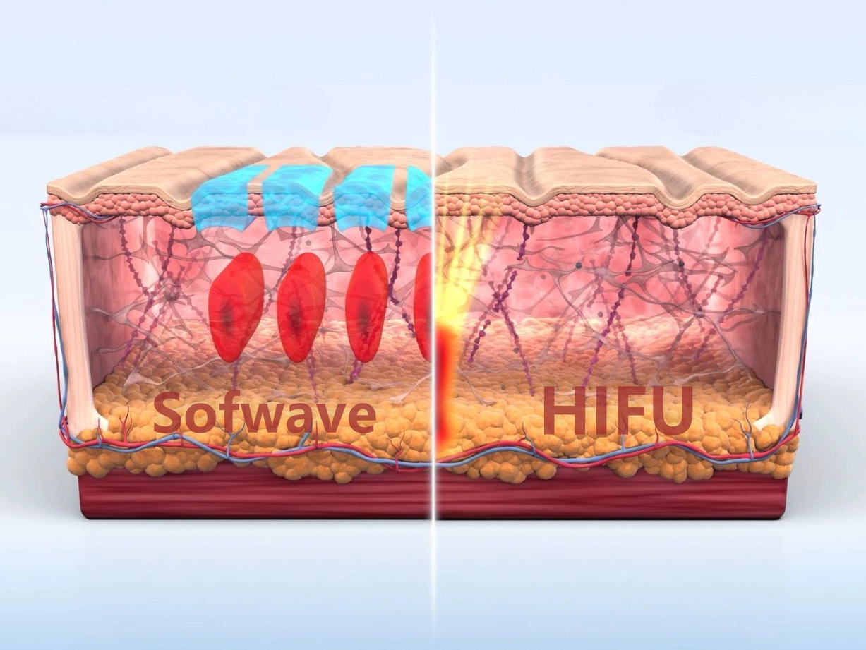 ソフウェーブとHIFUの違い