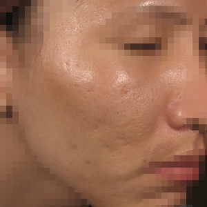 ニキビ跡治療症例写真1 20代男性 Before
