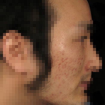 ニキビ跡治療 症例写真6 治療前 20代男性