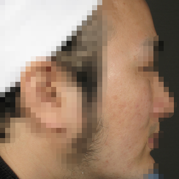 ニキビ跡治療 症例写真6 治療後 20代男性