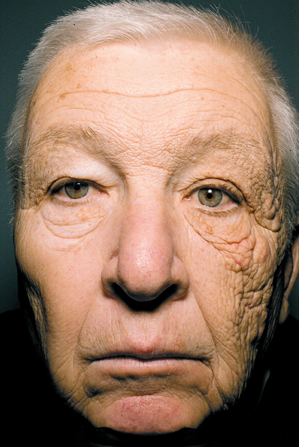 28年間トラック運転を続けた男性。片側性皮膚角化症