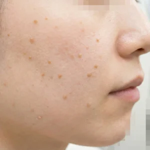 脂漏性角化症（老人性イボ）のイメージ